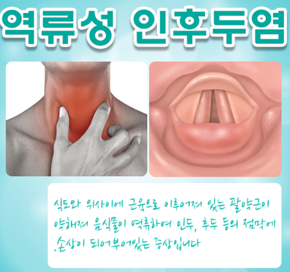 역류성 후두염