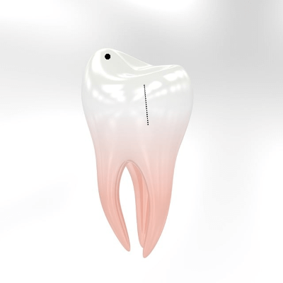 충치있는 치아