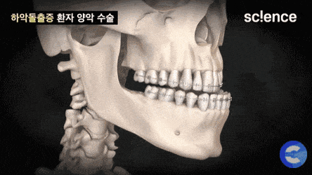  양악수술 과정