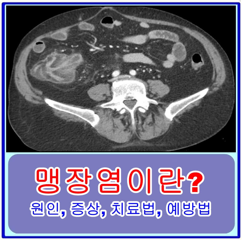 맹장염