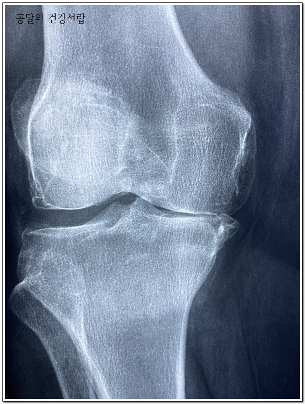 무릎관절 엑스레이 사진
