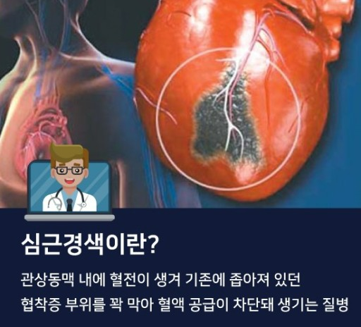  심혈관질환 중 심근경색에 대한 모든것 !!!