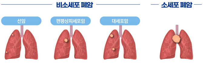 폐암