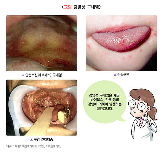  구내염