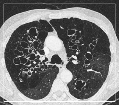 Low Dose Chest CT 검사와 주의사항은?