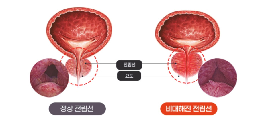 정상적인 전립선과 비대해진 전립선을 비교한 해부학적인 그림을 찍은 사진