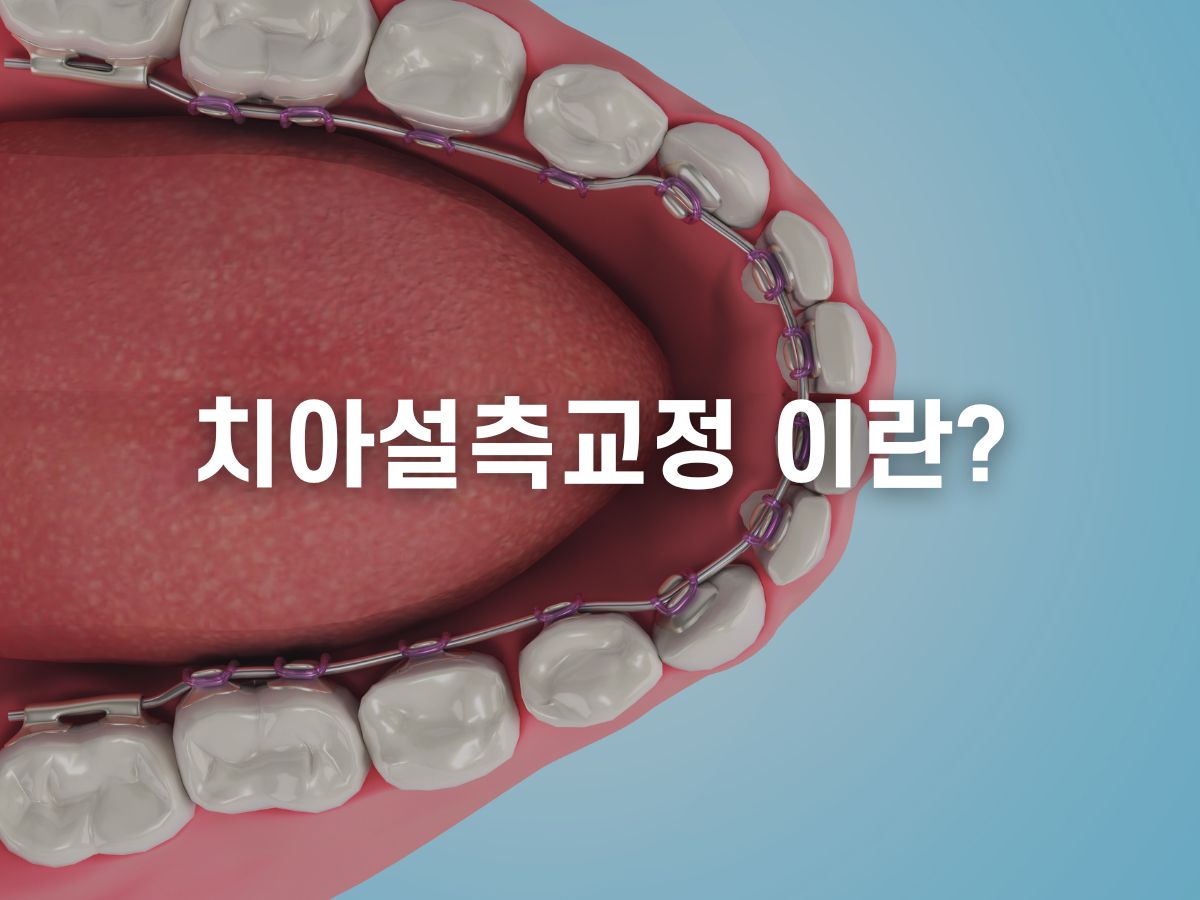 치아 설측교정 이란