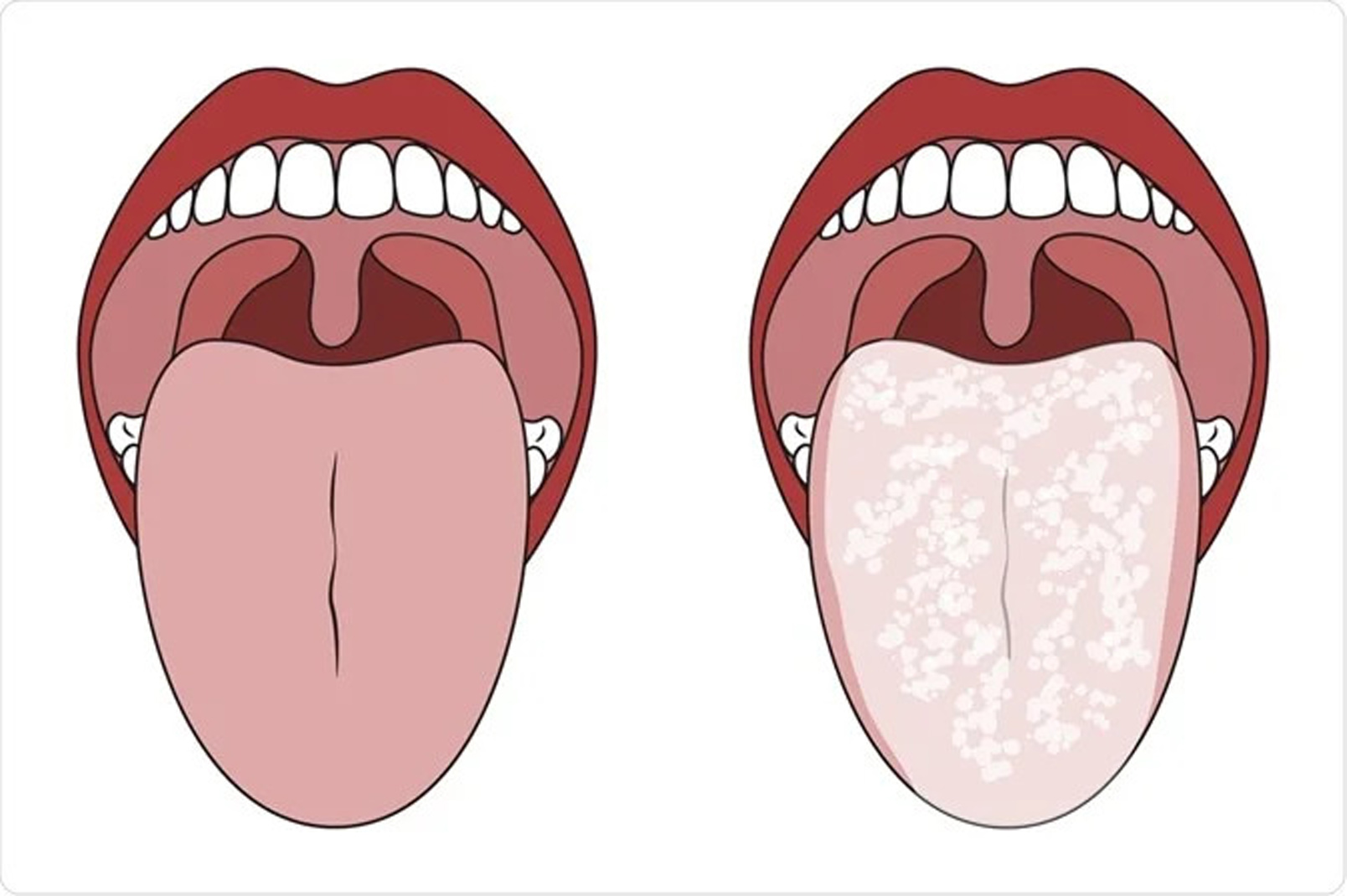 oral candinosis
