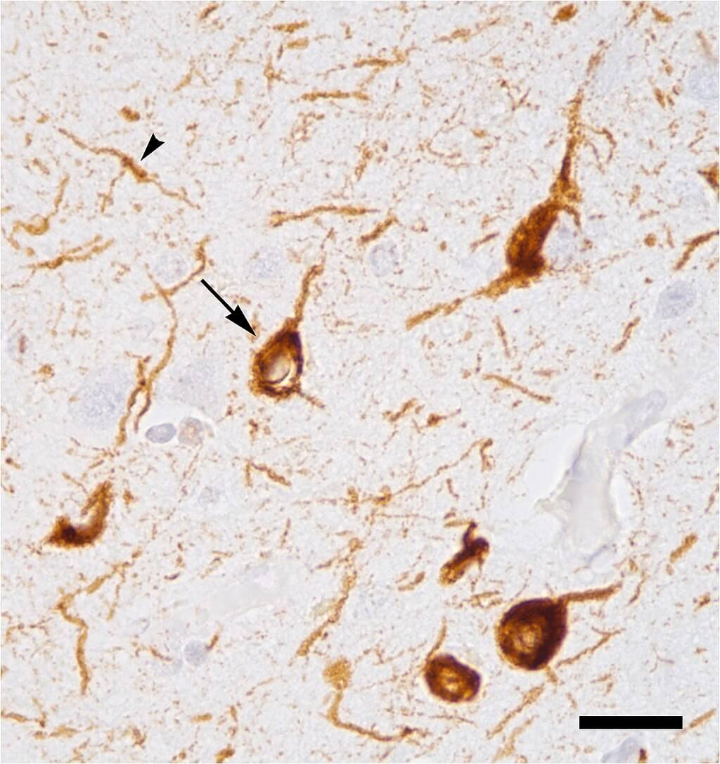 의학용어 A68 = tau protein 뜻 타우 단백질