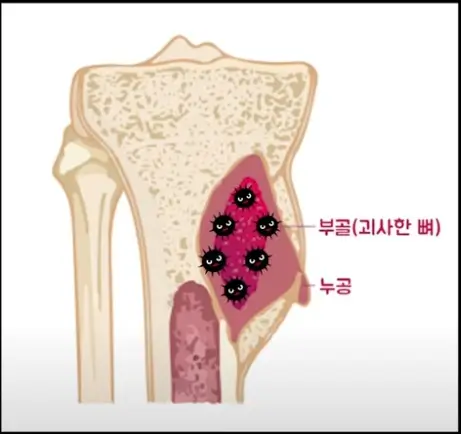 급성 골수염의 원인 및 증상 