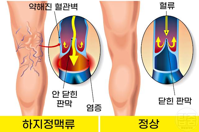 종아리 혈관 튀어나옴 하지정맥류 증상 예방