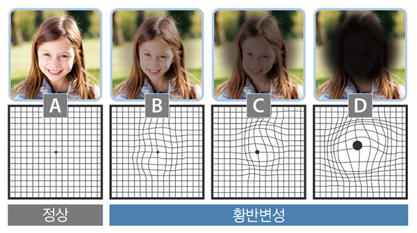  스마트폰으로 황반변성 환자 크게 증가와 대처법