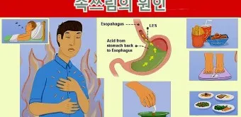 식후 속쓰림 원인 해결법 총정리_18