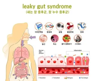 장누수증후군 증상 원인 치료법_23