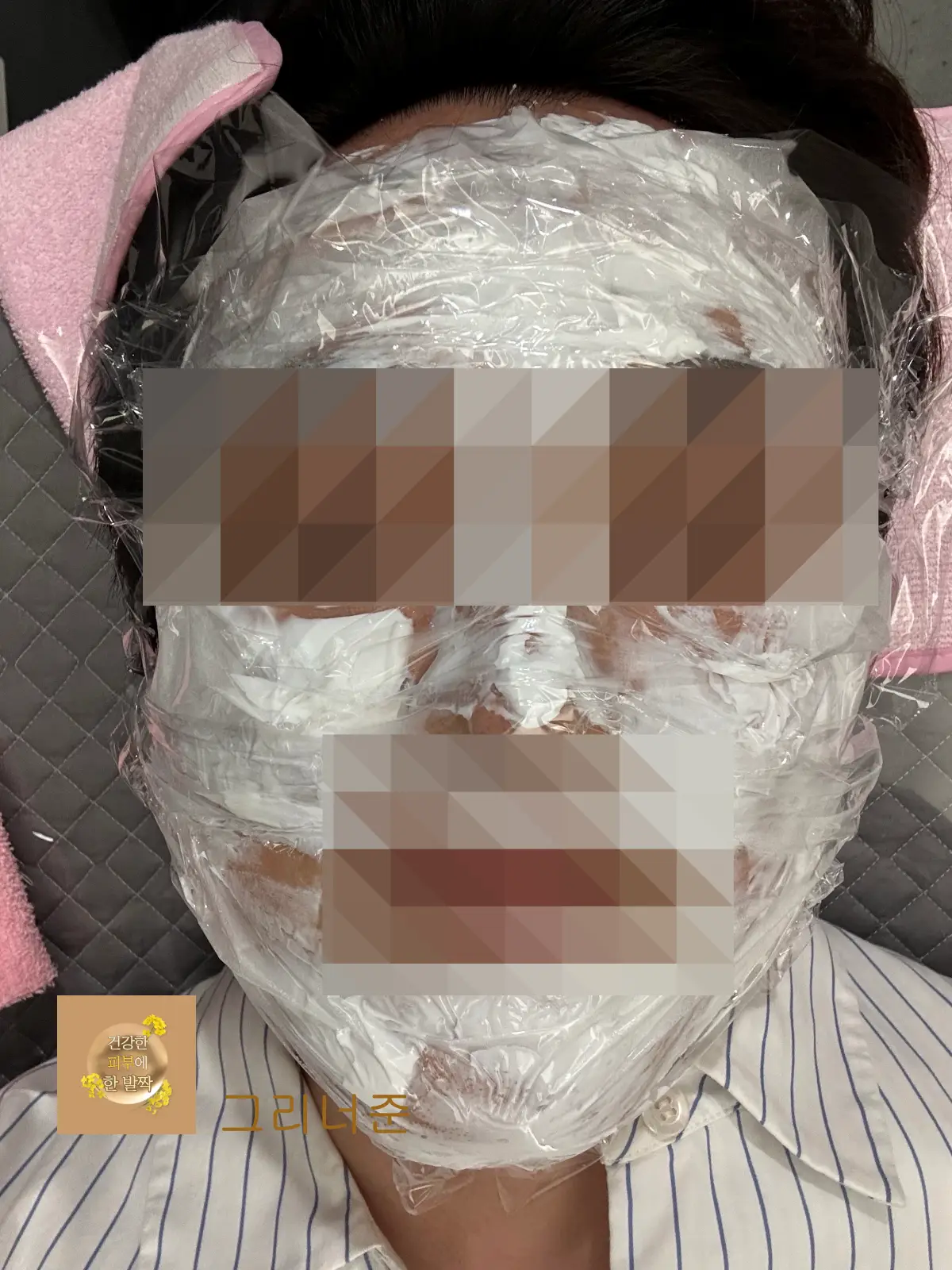 피부과-시술전-얼굴-전체-마취크림