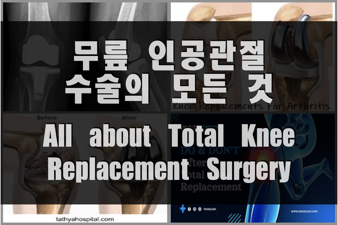  무릎 인공관절수술의 모든 것 (대상, 방법, 시간, 비용, 회복 및 재활운동법 등)