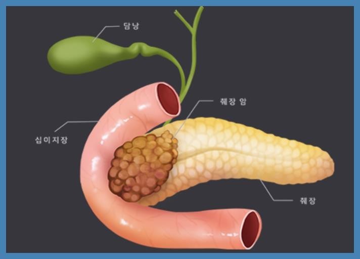 췌장암 초기증상 10가지 총 정리 :: 새개남