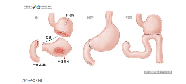 위암이해하기:증상&#44;원인&#44;진단&#44;치료방법