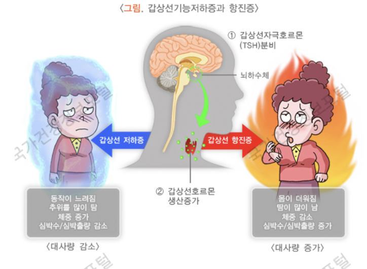 갑상선 저하증과 항진증