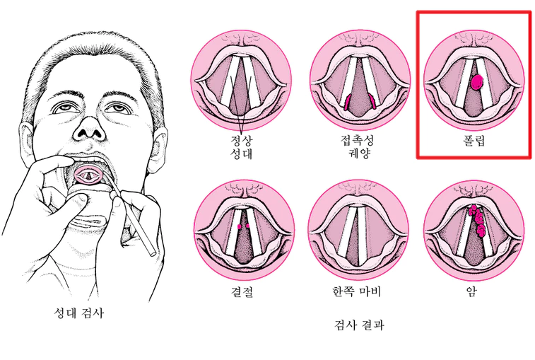 성대 폴립 이미지