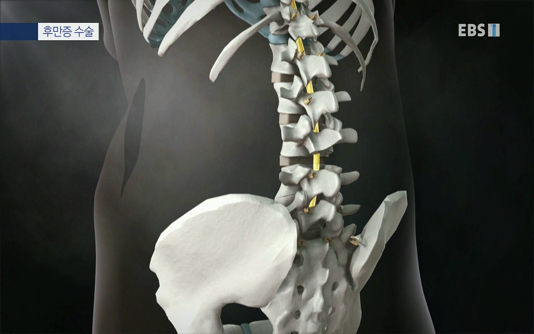 EBS 명의 헬스케어 - TV - 교육의 중심 EBS명의 15년 - 허리통증을 잡아라!.mp4_20220805_210307.991.jpg