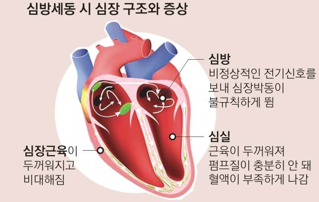 증상을 나타내는 심장의 구조