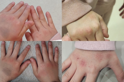 접촉성피부염 손 사진