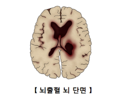 뇌출혈