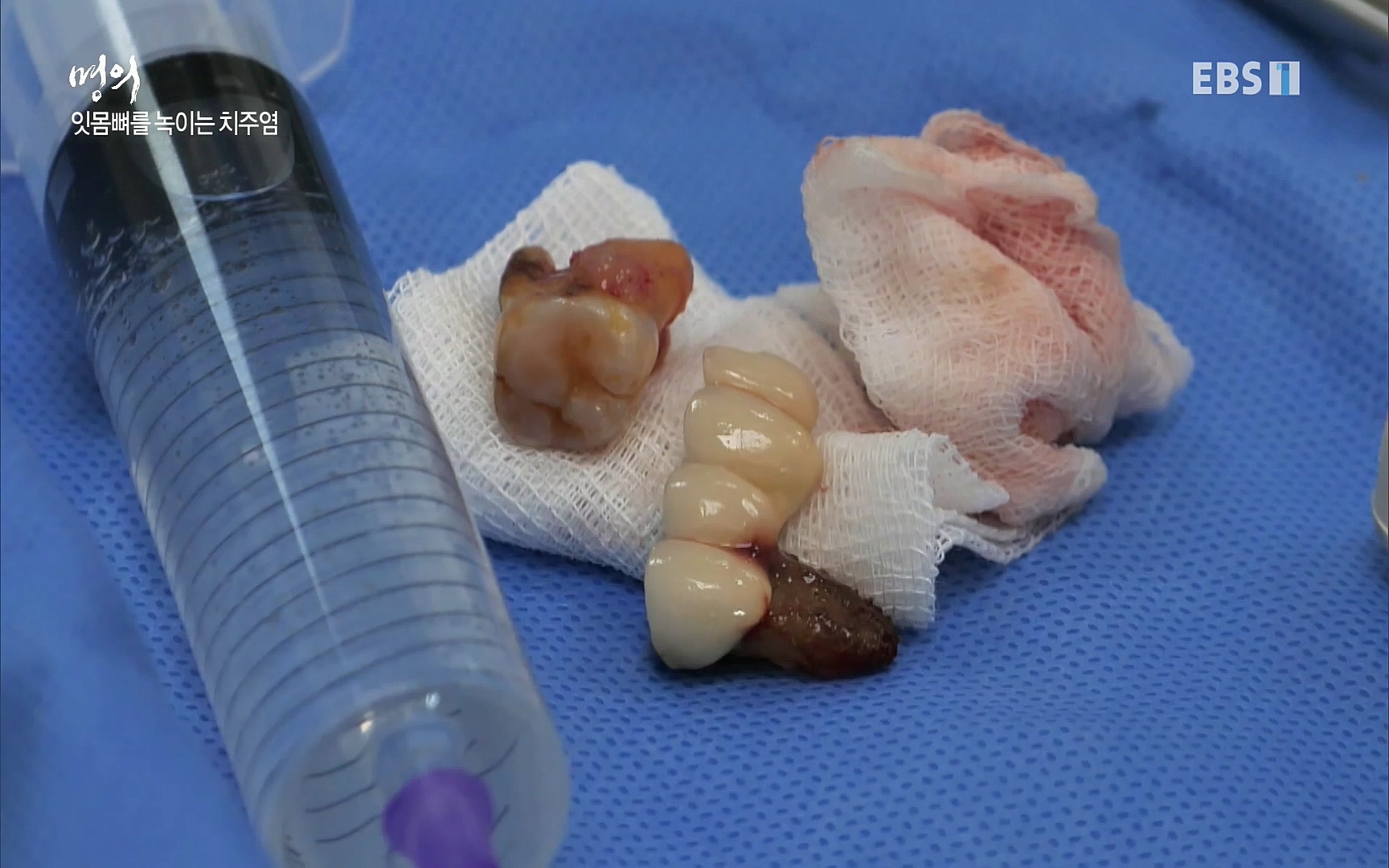 EBS 명의 헬스케어 - TV - 교육의 중심 EBS치주염이 코로나로 소홀해진 구강관리가 치아를 더 망가트리고 위험하게 만들며, 증상이 없기 때문에 특히 더 조심하고 치은염 단계에서 진행되지 않도록 예방해야한다 정의원 교수님과 치_20220505_151707.711.jpg