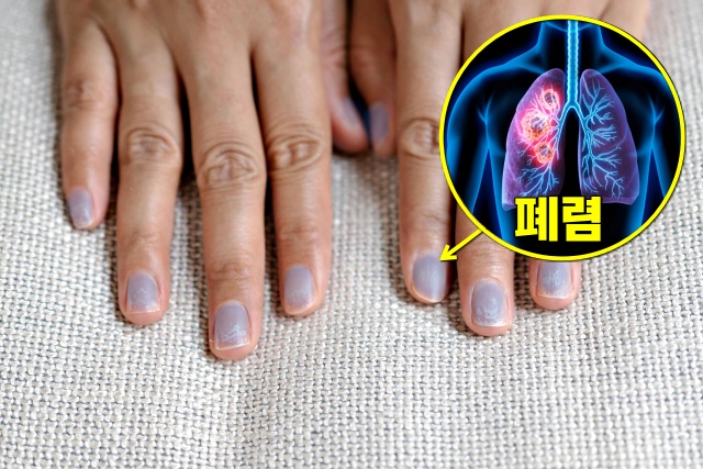 푸른색 손톱 폐렴 증상 청색증, 손톱으로 보는 건강상태, 건강 팁줌 매일꿀정보