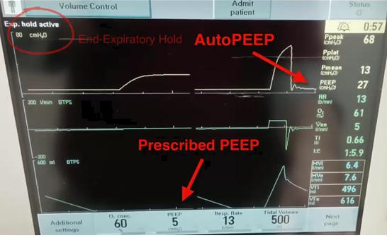 autoPEEP&amp;#44; servo-i
