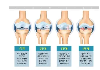 관절염 초기증상 류마티스 초기증상_25