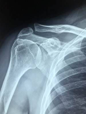 오른쪽 어때 뼈의 엑스레이 촬영 모습