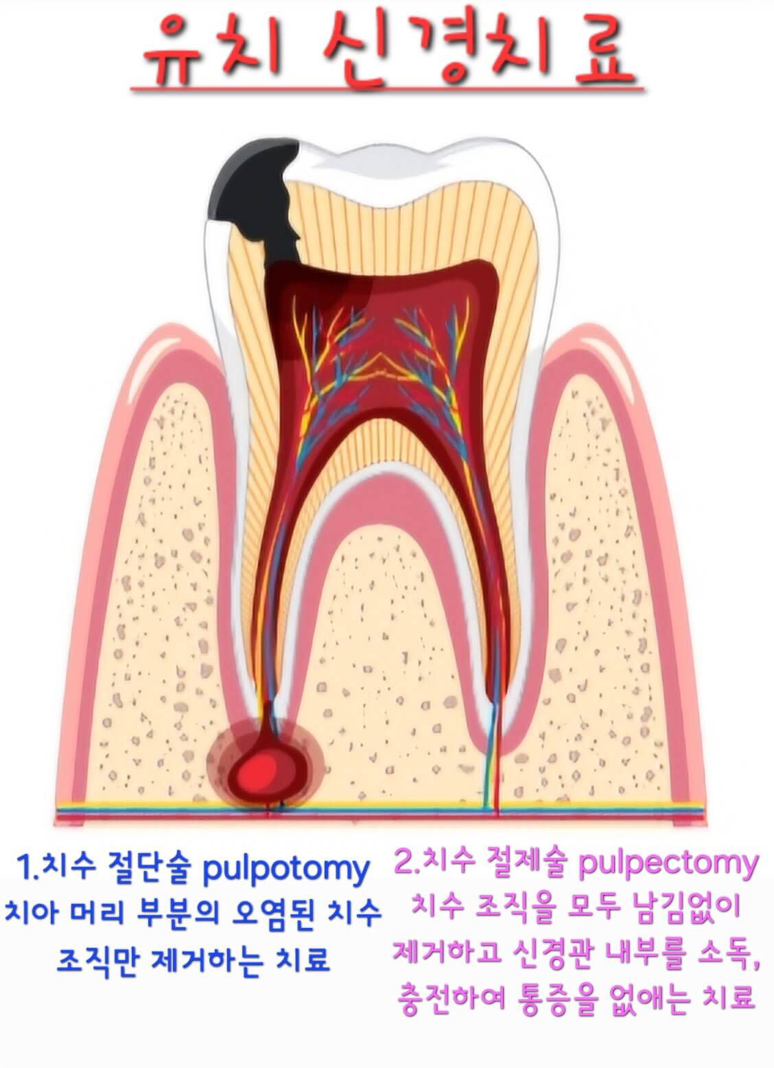 유치 신경치료