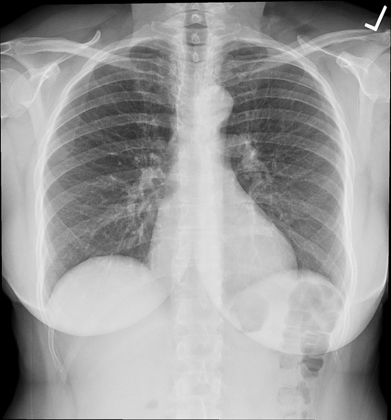 흉부-엑스레이-후전-방향-검사-사진