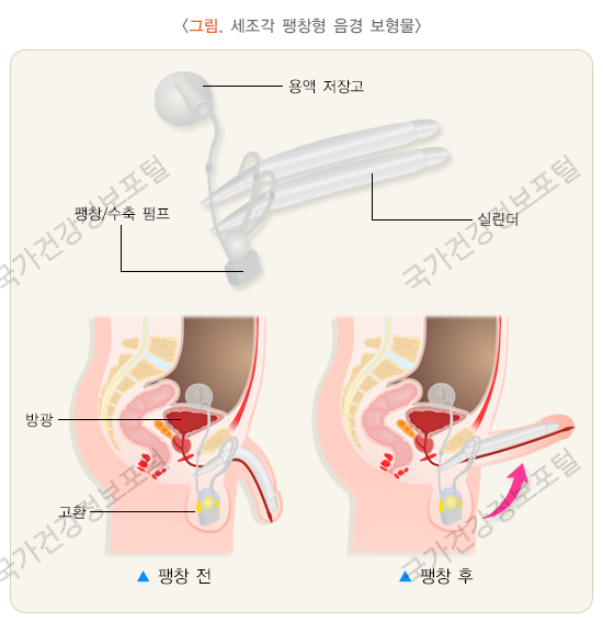 세조각 팽창형 음경 보형물-비약물 치료