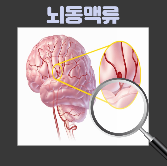 뇌동맥류&#44; 뇌 속 시한폭탄 심각한 위험