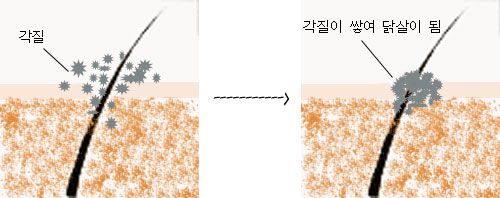 모공각화증 증상