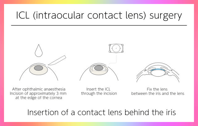 렌즈 삽입술 수술