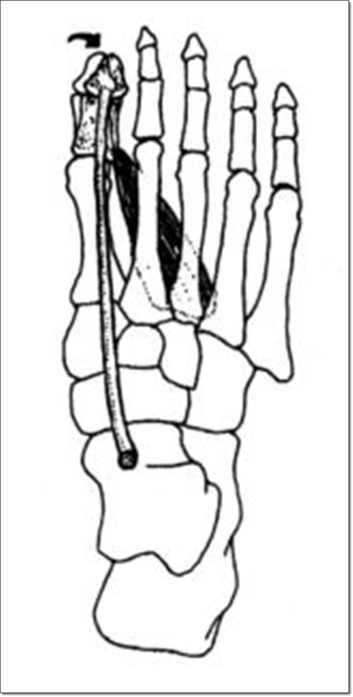 무지내전근 사선 섬유의 작용으로 엄지발가락에 변형이 나타나는 것을 나타낸 그림