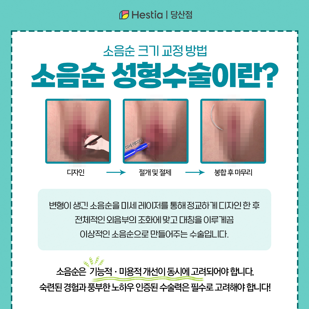 소음순 모양 크기 교정 방법은?
