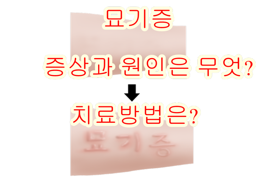  묘기증: 간지럽고 긁은 자국 그대로 남으시나요? 원인과 치료방법 알아보기
