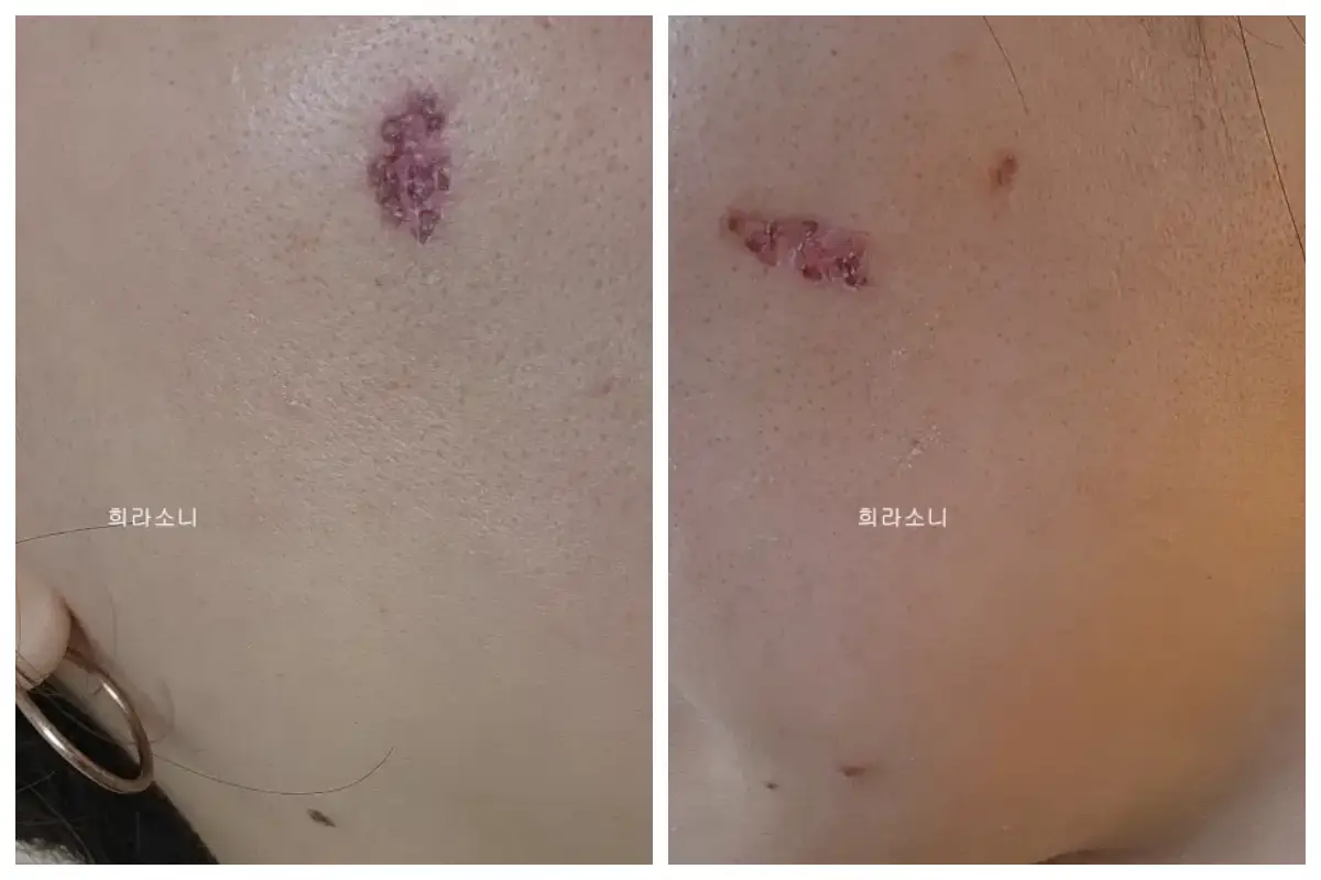 6월 22일의 사진. 갈색 딱지 군데군데가 약간 탈락된 모습.