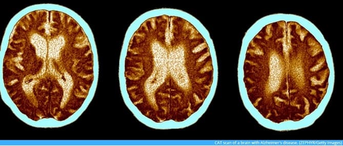 심각한 코로나 증상&#44; 20년 노화와 유사한 인지 장애 일으켜 Severe COVID-19 may cause similar cognitive deficits as 20 years of aging