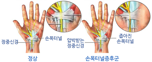  손목 터널 증후군 증상 4가지