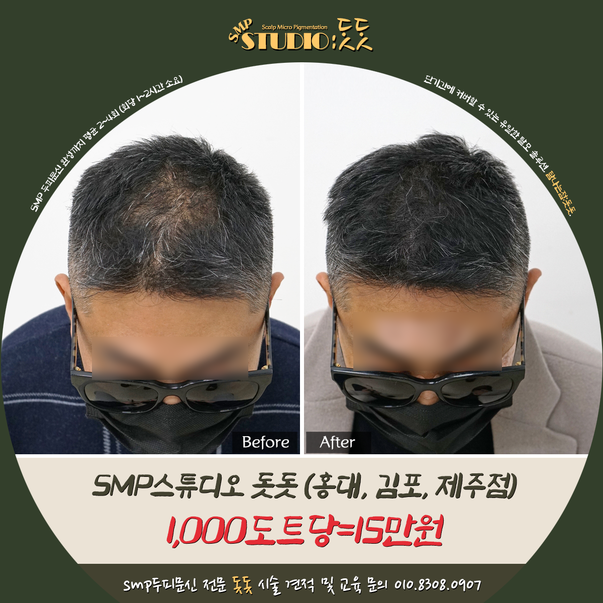  남자 헤어라인, 정수리 탈모 일산 SMP두피문신 후기