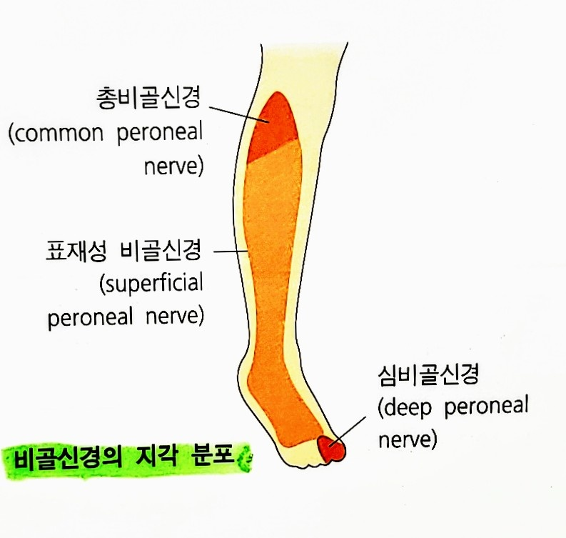  비골신경마비(peroneal nerve palsy)