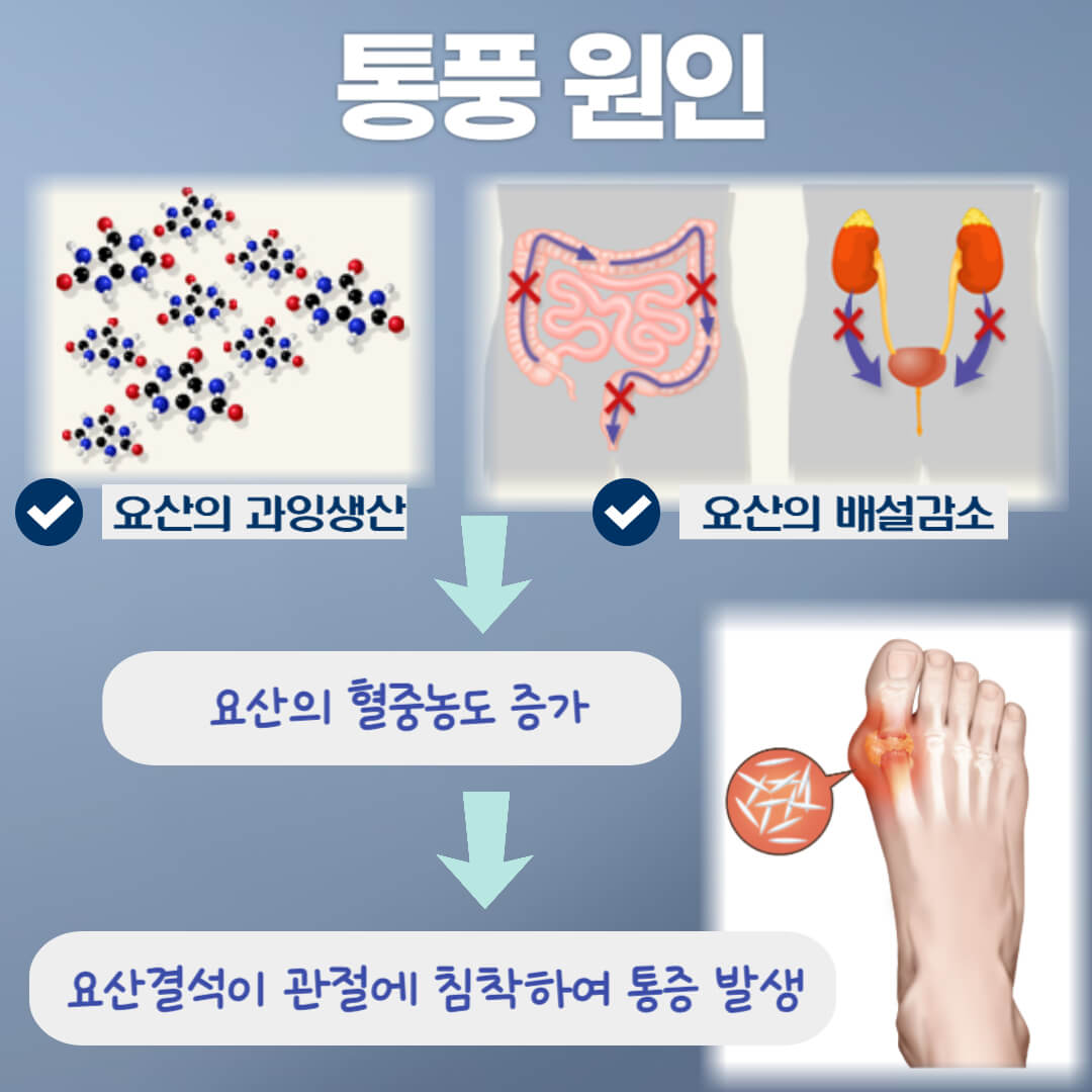 통풍 원인