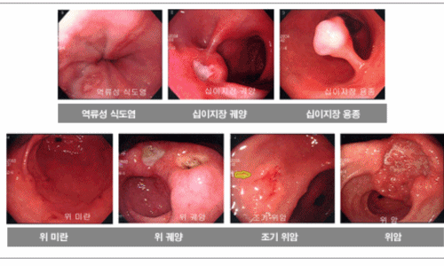 위암 이미지