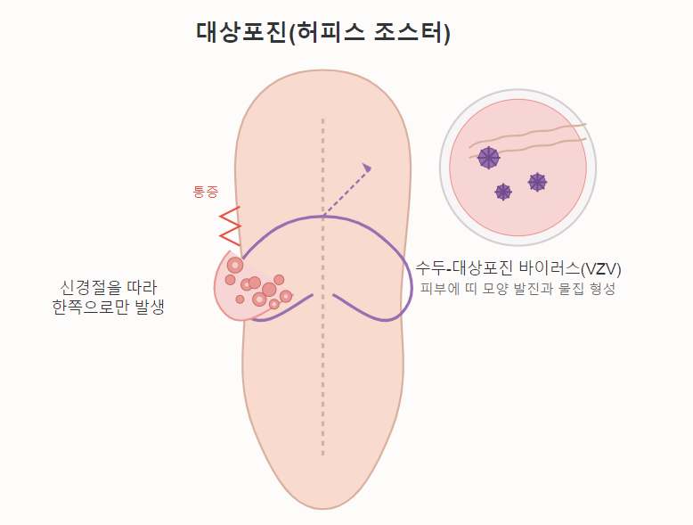 대상포진의 주요 특징을 적은 인포그래픽